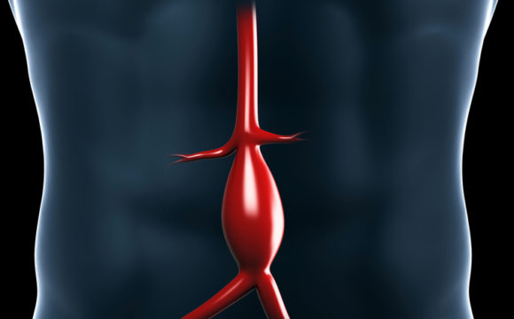Tętniak aorty piersiowo-brzusznej