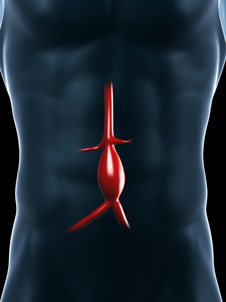 Tętniak aorty piersiowo-brzusznej