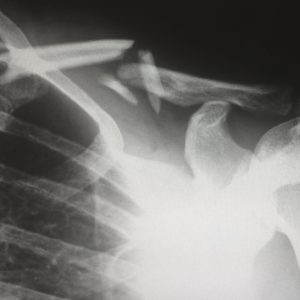 Osteoporoza- czym jest i jak się objawia?