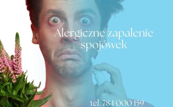 Alergiczne zapalenie spojówek – przyczyny, objawy, leczenie Alergiczne zapalenie spojówek – przyczyny, objawy, leczenie
